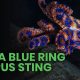 How to treat a blue ring octopus sting