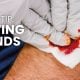 First Aid Tip: Treating Wounds